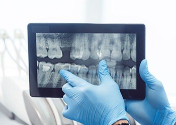 Digtal dental x-rays