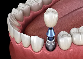 a computer illustration of a dental implant supported dental crown