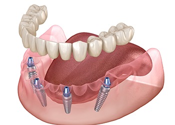 Illustration of all-on-x bottom denture and implants