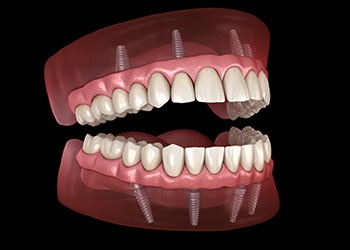 Digital illustration of all-on-X dental implants