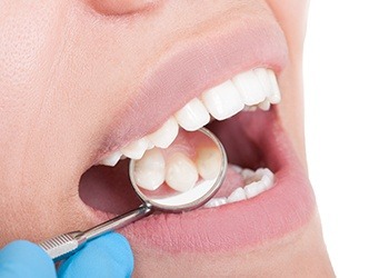 Closeup of flawless healthy smile after metal free dental restorations