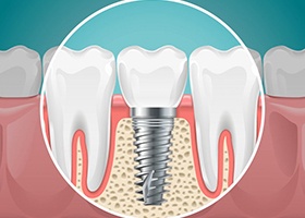dental implant post in the lower jaw bone graft