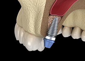 dental implant post in the back upper jaw after sinus lift