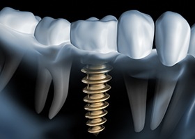 Animated dental implant supported dental crown