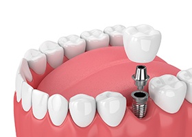 dental implant, abutment, and dental crown being placed in the lower jaw