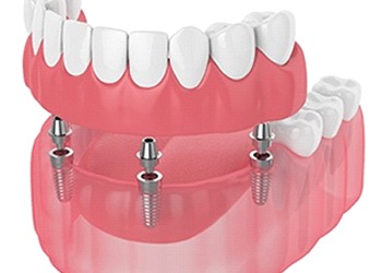 A digital image of a dental implant supported denture being put into place to replace missing teeth along the lower arch