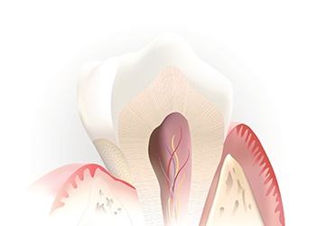 Animation of the inside of the tooth before root canal therapy