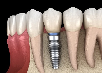 single dental implant in the lower jaw