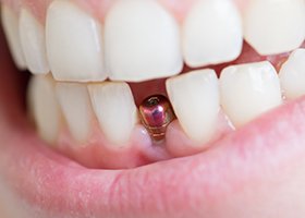 a mouth with a dental implant showing through the gumline