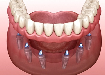 A digital image of 6 dental implants surgically placed along the lower arch and a dental implant supported denture placed on top