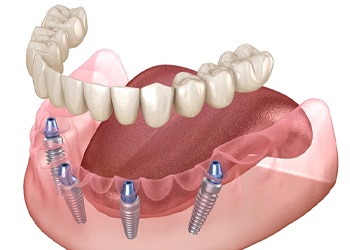 A digital model of a lower arch with four dental implants and a dental implant supported denture