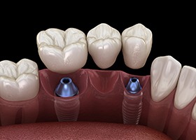a computer illustration of a dental implant supported fixed bridge
