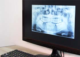 Digital X-Rays in Crown Point
