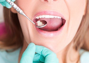 Closeup of teeth during dental exam after tooth colored filling treatment