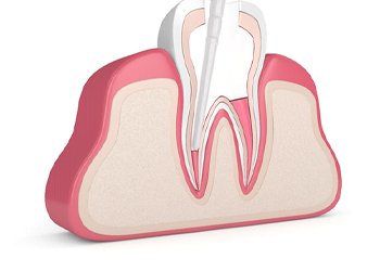 Digital illustration of root canals in Crown Point