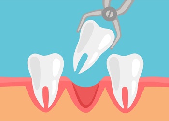 illustration of tooth extractions in Crown Point 