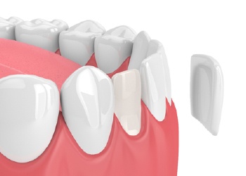 Illustration of porcelain veneer placement