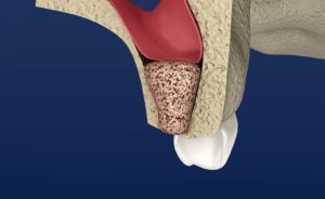 Bone graft used before dental implant placement