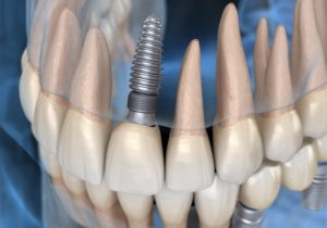 Dental implant replacing front tooth