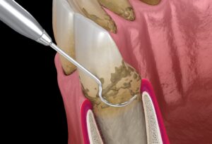 Digital image of scaling and root planing